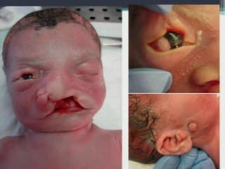 Syndrome de PAI : apport de l'échographie et de l'IRM 3D.