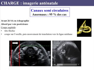 Syndromologie : syndrome CHARGE, de la génétique à l’imagerie*