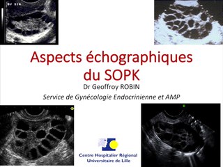 Aspects échographiques du syndrome des ovaires polykystiques