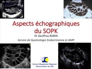 Aspects échographiques du syndrome des ovaires polykystiques
