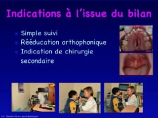 Fente labio-palatine Prise en charge orthophonique