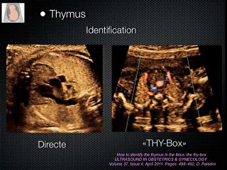 Malformations cardiaques : Le bilan morphologique commence à la découverte d'une cardiopathie ou la « check-list » syndromique :