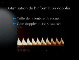 Optimisation de l’utilisation du doppler