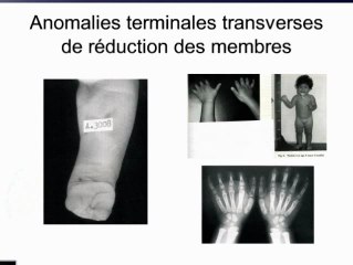 Misoprostol et risque iatrogène