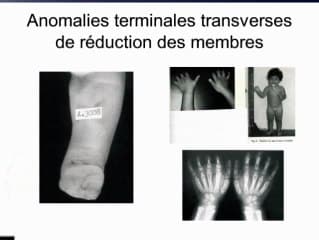 Misoprostol et risque iatrogène