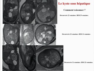 kyste sous hépatique