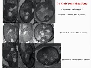 kyste sous hépatique