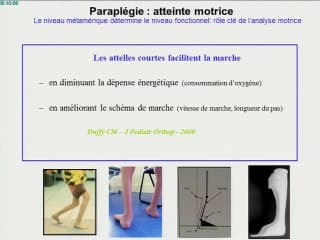 pronostic des myeloméningoceles