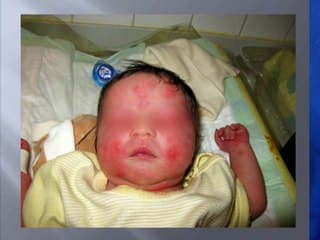 La microdélétion 22q11