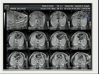 L'échographie de dépistage « revisitée ». Les coupes « obligatoires » et les coupes souhaitables. Les trucs et astuces pour y arriver.