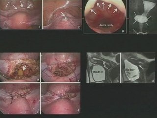 Cicatrice de césarienne : du normal au pathologique