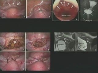 Cicatrice de césarienne : du normal au pathologique