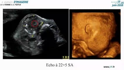 Hétérotopie neurogliale trachéale