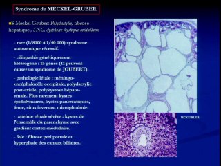 Anatomopathologie des dysplasies rénales et pronostic des différents syndromes. Sémiologie échographique du parenchyme rénal, du normal au pathologique. Peut-on différencier les pathologies du parenchyme rénal in utero ?