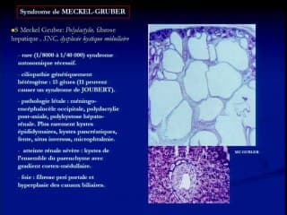 Anatomopathologie des dysplasies rénales et pronostic des différents syndromes. Sémiologie échographique du parenchyme rénal, du normal au pathologique. Peut-on différencier les pathologies du parenchyme rénal in utero ?