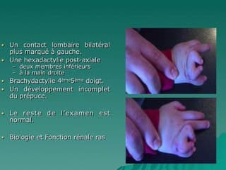 syndrome de Bardet Biedel