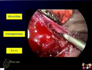 Séquestration pulmonaire