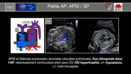 Coeur foetal I : c’est trop petit ! Petite artère pulmonaire et Fallot
