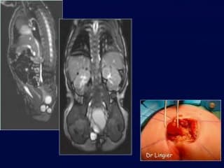 Imagerie des kystes abdominaux foetaux