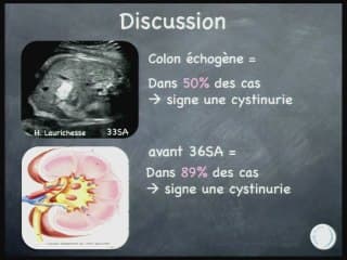 Le côlon hyperéchogène s'éclaire.