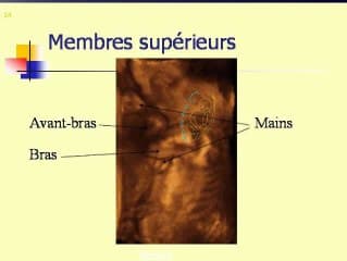 Micromélie (ostéogénèse imparfaite)