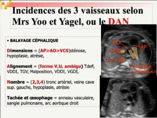 Echocardiographie fœtale de dépistage