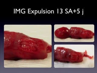 Dépakine et grossesse : quel bilan échographique ?