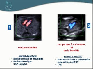 Des recommandations du CTN à la suspicion d’anomalie d’organe au 1er trimestre. Gérer la chaîne diagnostique :Coeur.