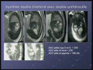 Diffusion rénale.