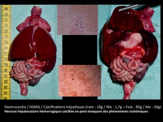 Imagerie du syndrome de Caffey à révélation anténatale : à propos d'une observation récidivante