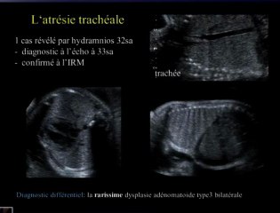 Diagnostic différentiel des dysplasies pulmonaires : Méthodes - Limites - Intérêt