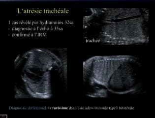 Diagnostic différentiel des dysplasies pulmonaires : Méthodes - Limites - Intérêt