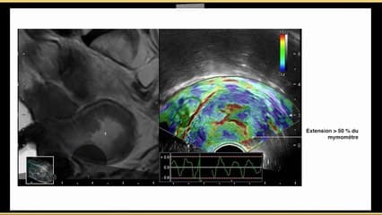 Images échographiques complexes Corrélations imagerie (échographie 3D,IRM, fusion)