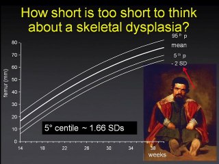 l' os foetal  ( en ANGLAIS )