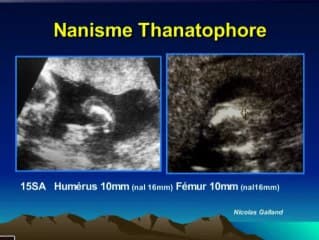 Echographie du 1er trimestre, jusqu'ou peut on aller : anomalies du squelette