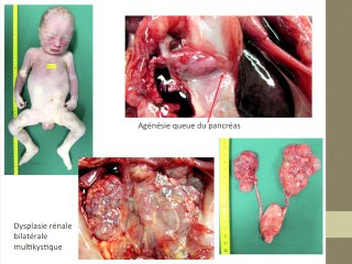 Spectre des maladies par mutations du gène TCF2 A propos de 3 cas de foetus humains porteurs de malformations rénales sévères et d'anomalies pancréatiques