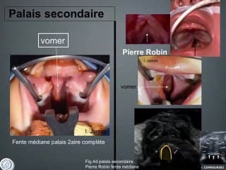 Séquence de Pierre Robin : quand et pourquoi la suspecter ?