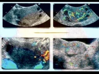 Gynécologie endocrinienne, de la clinique à l’image.