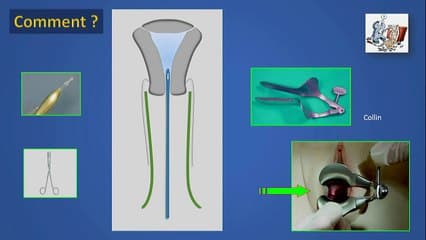 Hydrosonographie, quand, comment, pourquoi ?