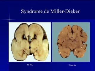 Hétérotopie, pachygyrie et lissencéphalie