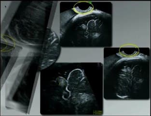 Sclérose tubéreuse de Bourneville
