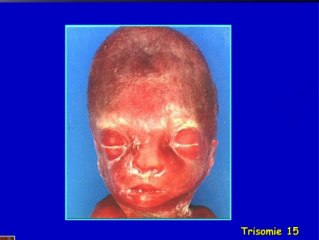 Mosaïque confinée au placenta (cas clinique)