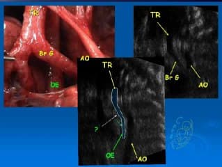 L'oesophage foetal