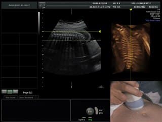 Le point sur le spina bifida : 2e et 3e trimestre : De la sémiologie de base aux signes subtils