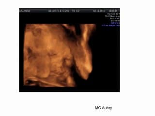 RCIU et cataracte bilatérale