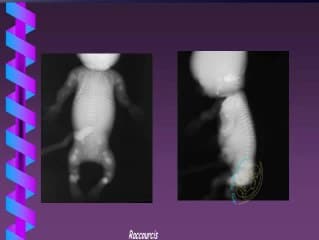 Epidémiologie des anomalies osseuse en Rhône-Alpes-Auvergne