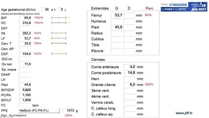 Craniosténose à propos d'un cas clinique