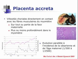 Echographie de contraste et placenta accreta
