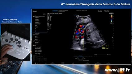 CROISSANCE ET BIEN-ÊTRE DU FŒTUS : Live on demand* Dopplers