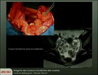 Ovaires : tumeurs borderline de l'ovaire